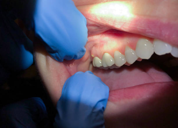 Best Emergency Root Canal Treatment in Sigourney, IA