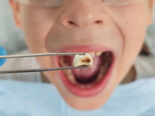 Best Emergency Wisdom Teeth Removal in Sigourney, IA